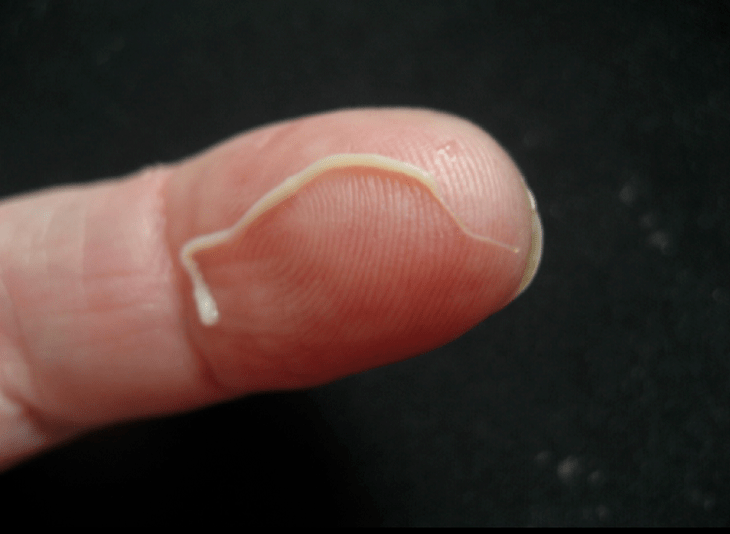 roundworm parasitoa giza gorputza